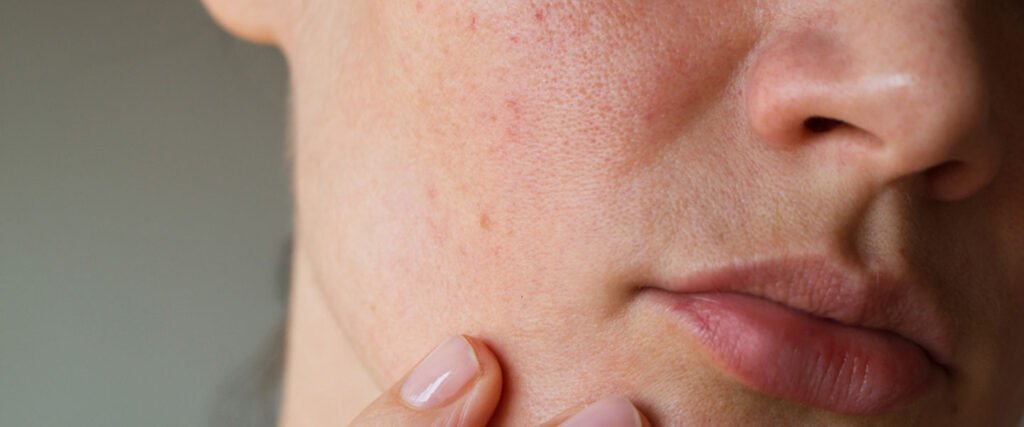 Cilt Lekeleri Neden Oluşur? Güneş, Genetik ve Hormonal Faktörlerin Etkileri